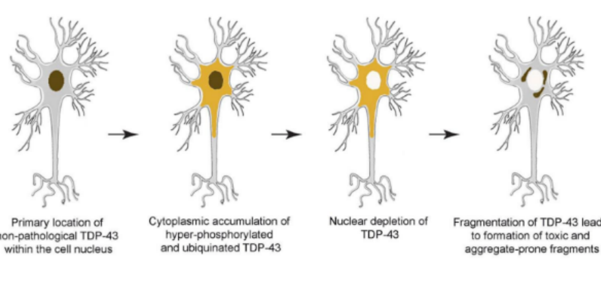 <p>def. LATE</p><p>__</p><p>t/f: LATE involves a different anatomical pattern/path for the spread of aggregate pathology compared to AD</p><ul><li><p>explain how (1)</p></li><li><p>how will it affect normal vs. toxic function?</p></li></ul><p>_</p><p>explain the hypothesis relating to spread and “seed” aggregates (1)</p><div data-type="horizontalRule"><hr></div><p>t/f: LATE dementia &amp; ALS are different diseases, and are only related b/c they both involve TDP-43 pathology</p>