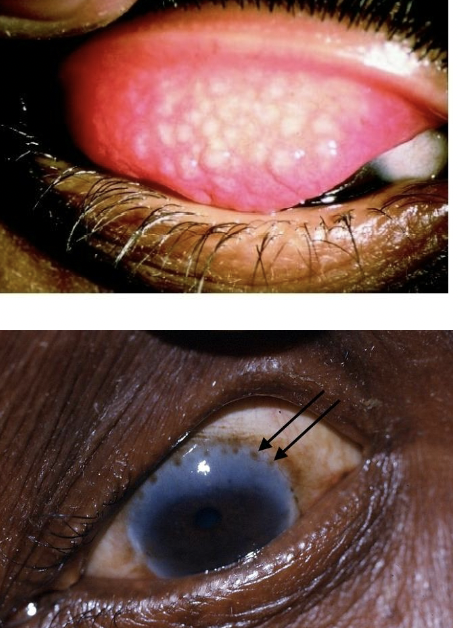 <p>Causes chronic inflammation and scarring of <u>eyelid/conjunctiva</u></p><ul><li><p>Organism: Chlamydia trachomatis</p></li><li><p>Transmission: Eye secretions</p></li><li><p>Prevention: Hygiene</p></li><li><p>Treatment: <u>Antibiotics</u></p></li><li><p>Epidemiology: Prevalent worldwide</p></li></ul><p></p>