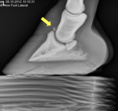 <p>What is the treatment for a type IV P3 fracture?</p>