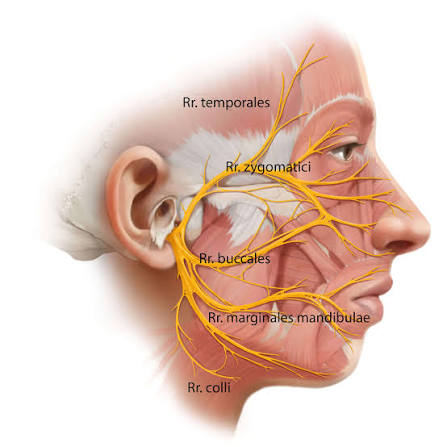 <p>-valódi eredési helyei: magcsoport a hídban</p><ol><li><p><strong>Nucleus motorius nervi facialis</strong> (szomatomotoros ) = mimikai izmok</p></li><li><p><strong>Nucleus salivatorius superio</strong>r (paraszimpatikus, szekretomotoros) = nyálmirigyekhez (kivéve a parotist) és könnymirigyekhez 2.2 a <strong>n. intermedius (Wrisberg, VII.bis)</strong></p></li><li><p><strong>Nucleus tractus solitarii (Nageotte féle nucleus gustatorius) </strong>= ízlelő rostok végződése, a nyelv elülső részére</p></li></ol><p>-látszólagos eredés: nyúltagy-hídi barázdából laterálisan, vastagabb gyökér a VII.nek és vékonyabb a VII.bisnek</p>