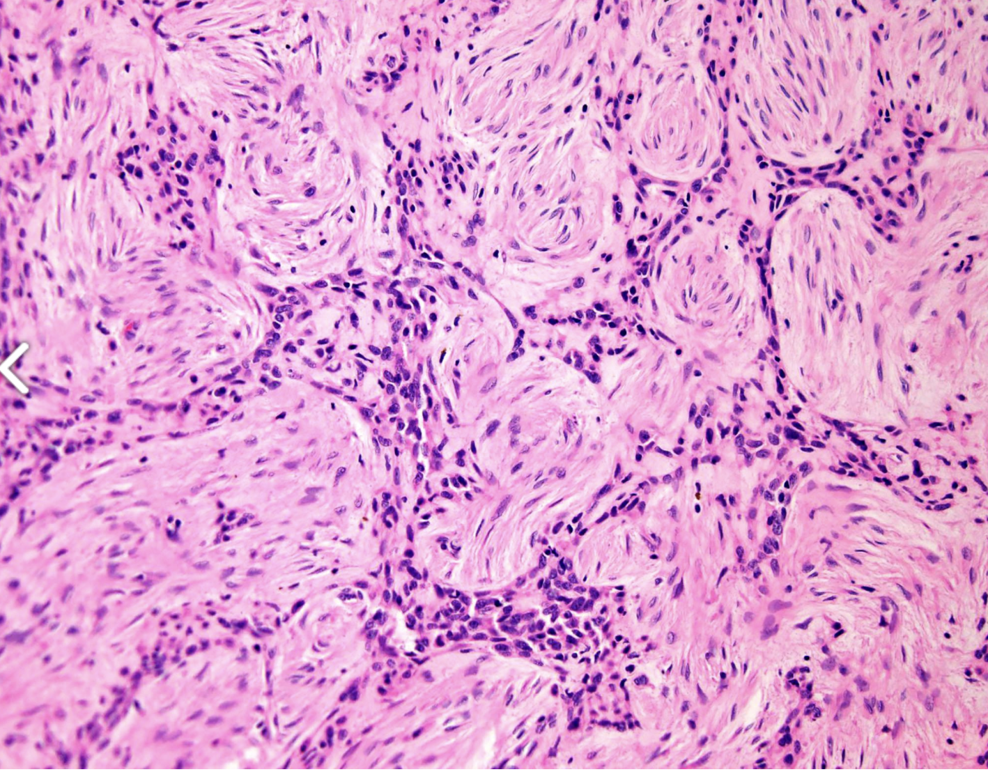 <p>Tumeur tibia antérieur patient de 20 ans </p><p>diagnostic</p><p>définition</p><p>age</p><p>topographie</p><p>anatomie</p><p>histologie</p><p>IHC </p><p>moléculaire</p>