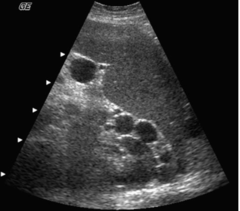 <p>A 49-year-old male presented with a clinical history of liver cirrhosis and portal hypertension. In the transverse image below, multiple hypoechoic structures are seen at the splenic hilum and between the kidney and spleen. What is the most likely etiology of these structures.</p><p>a. multiple aneurysms of the splenic artery</p><p>b. splenic and retroperitoneal varices</p><p>c. loculated ascites</p><p>d. polycystic kidney disease</p><p>e. fluid-filled loops of bowel</p>