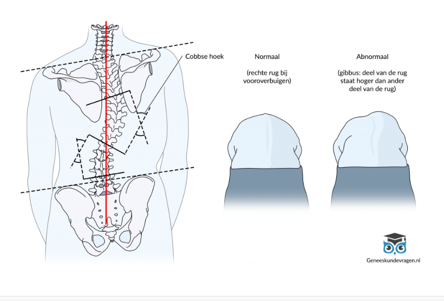 <p>=> Men spreekt van scoliose als er in de rug een verkromming is naar links of rechts.</p><ol><li><p>De soepele, niet-structurele scoliose → er is geen draaiing of torsie van de wervelkolom om zijn lengteas. Er is geen gibbus aanwezig. Deze vorm is volledig corrigeerbaar. Bij kinderen rond de tien jaar wordt soms een lichte vorm gevonden die verdwijnt bij vooroverbuigen en bij het ouder worden ook weg is. Deze scoliose wordt als fysiologisch beschouwd.</p></li><li><p>De stugge, structurele scoliose → er is draaiing of torsie van de wervelkolom om zijn eigen lengteas. De torsie kan een asymmetrie in de stand van de schouders, het bekken en de luchtfiguur tussen de arm en de romp. De ribben puilen aan één kant uit (=gibbus).</p></li></ol><p>=> Het onderscheid tussen de vormen wordt gemaakt met een buigtest. Het kind buigt voorover met de armen los naar beneden terwijl de arts achter hem staat. Bij een structurele scoliose blijft de zijdelingse bocht in de rug aanwezig en is de torsie duidelijk zichtbaar aangezien de linker en rechter lichaamshelft niet meer even hoog staan, die gebeurd in principe niet bij niet-structurele. Met de buigtest in combinatie met de Hoek van Cobb kan je het type en de ernst bepalen.</p>