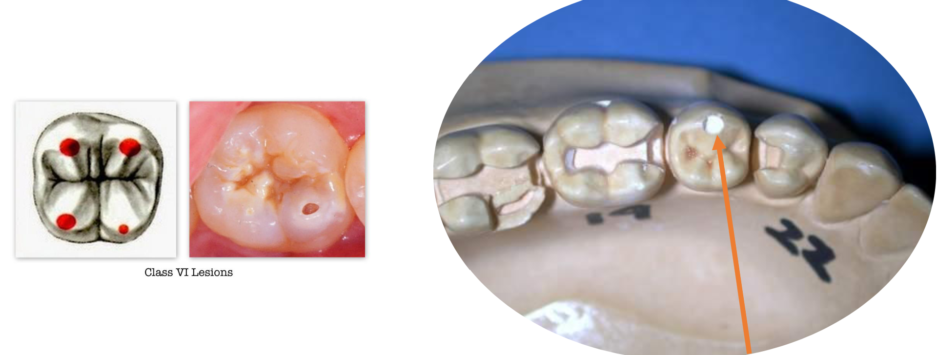 <p>Incisal edges of anterior teeth and occlusal cusp tips of posterior teeth</p>
