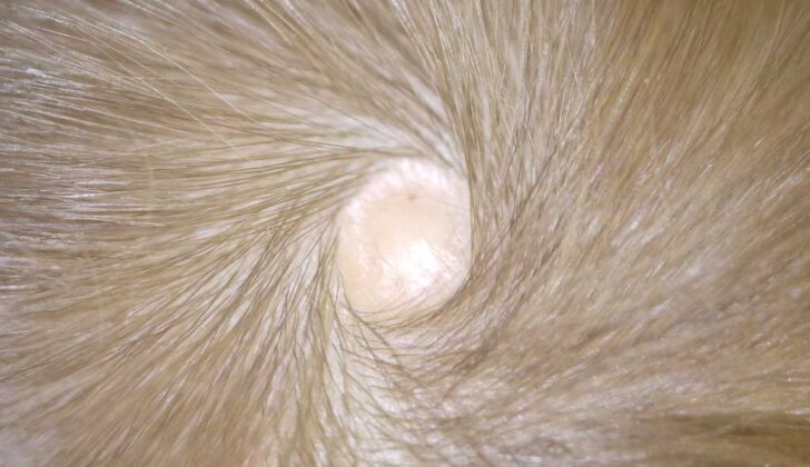 <p>aplasia cutis</p>