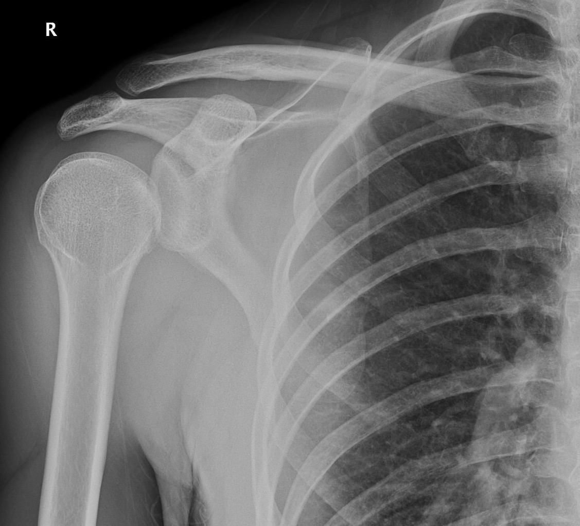 <p>Shoulder dislocation (Posterior) <span data-name="star" data-type="emoji">⭐</span></p>