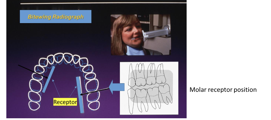 <p>-Anterior film/ receptor edge should be at the mesial of the second premolar or more posterior.</p><p>- Posterior film/ receptor edge should cover 2m.m posterior to the last standing tooth.</p><p>- The film/ receptor should slide into the palatal vault as the patient is closing.</p><p>-Keep the film/ receptor away from the gingival ridge.</p><p>-Keep a gentle pull on the tab by holding the tip of the tab till the patient bites on it, this prevents the film/ receptor from tipping.</p>