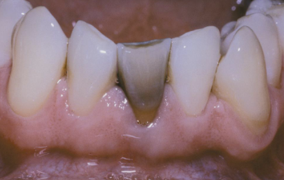 <p>pulp death after RCT or trauma, age (gets darker with time), tooth is brittle, rx post and crown</p>