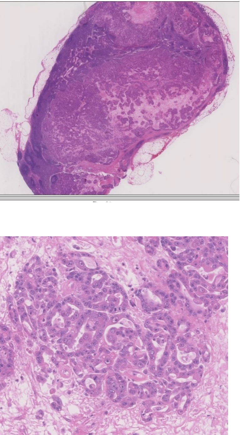 <p>Metastasis to a Lymph Node - Where might this tumour have come from and by what route might it have spread?</p>
