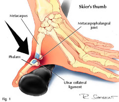 <p>Sprain/ rupture of ulnar collateral ligament of MCP joint of first digit. Result in medial instability of thumb. Usually occurs with skiers . Immobilized for 6 wks</p>