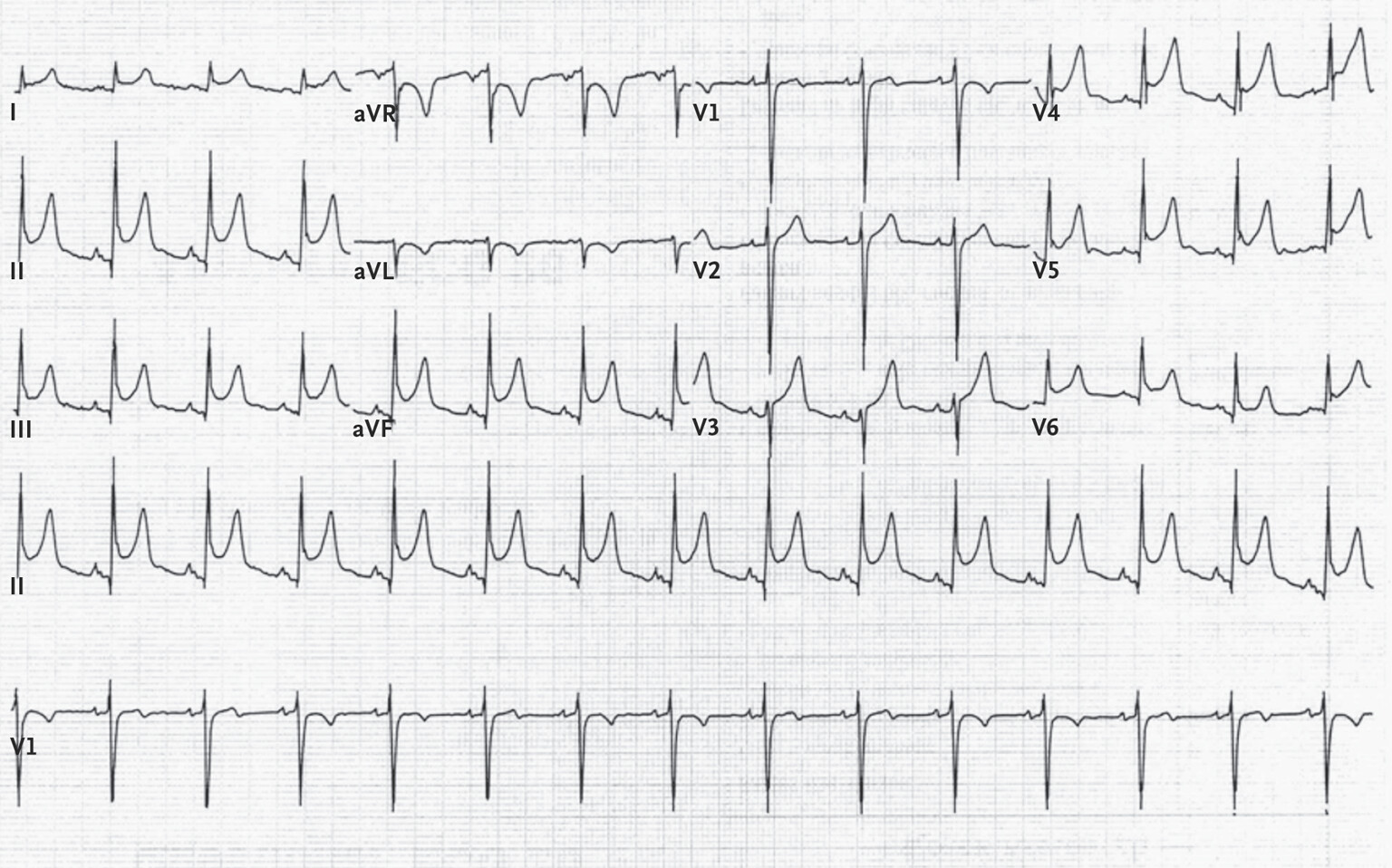 <p>howd yk this is pericarditis</p>