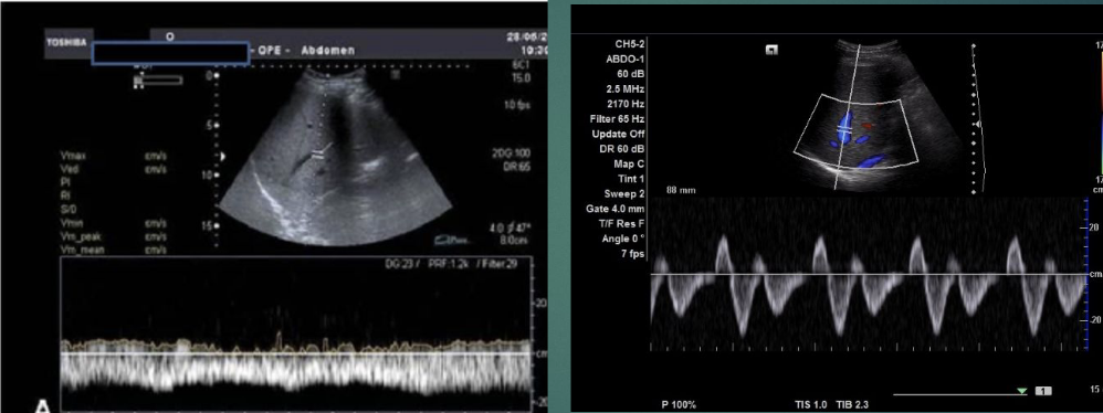 <p>the hepatic vein waveform commonly becomes monophasic (flat or blunted) in patients with cirrhosis, departing from the normal triphasic pattern</p>