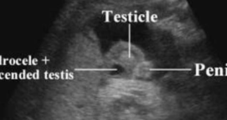 <ul><li><p>if descent interrupted or stopped testes will remain located within inguinal canal</p></li><li><p>referred to as undescended testes, or cryptorchidism</p></li><li><p>risk of torsion and development of cancer</p></li><li><p>scrotal sac with no testicular tissue</p></li><li><p>SONO: anechoic fluid seen in scrotum</p></li></ul><p></p>
