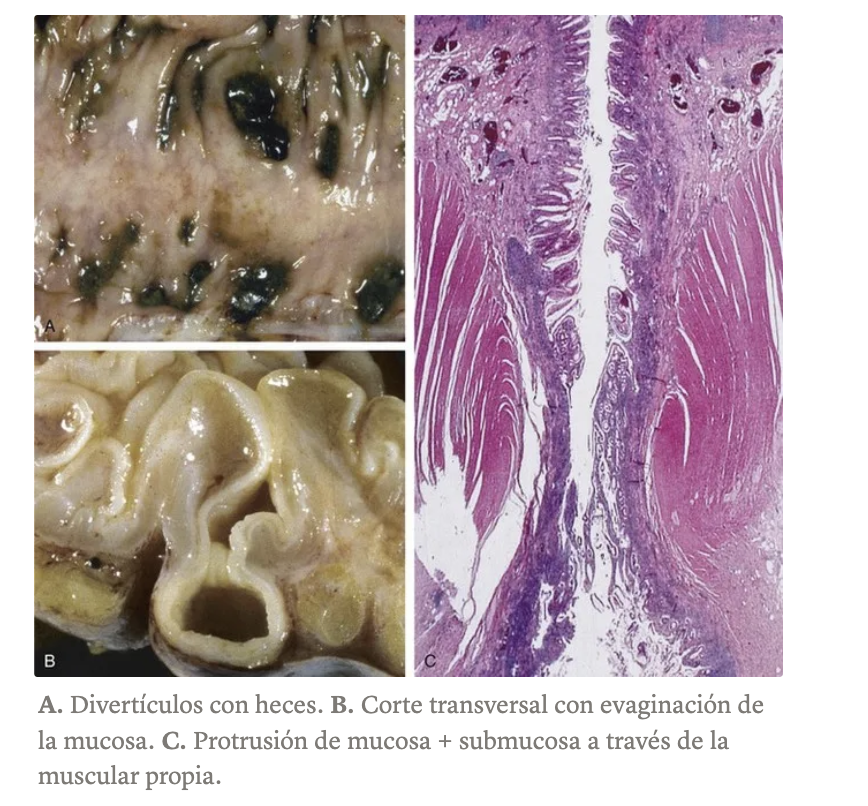 <p>Diverticulosis / Diverticulitis </p>