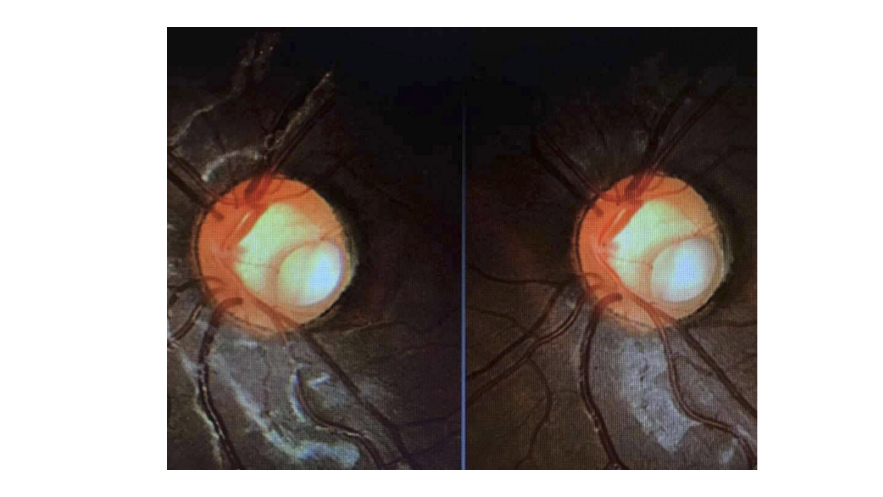 <ul><li><p>Congenital excavation of the optic disc</p></li><li><p>Appears as a round or oval pit</p></li><li><p>Usually located in the inferotemporal (lower temporal) quadrant of the optic disc</p></li></ul><p></p>
