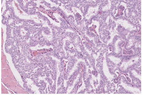 <p>Carcinome papillaire encapsulé </p><p>1) localisation des cellules myoépithéliales</p><p>2) morphologie</p><p>3) staging </p><p>4) définition vraie invasion</p><p>5) molécualire</p>