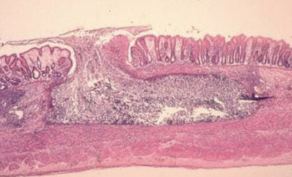 <p>1) entamoeba histolytica </p><p>2) </p><ul><li><p>ulcère en forme de flasque (photo) </p></li><li><p>Cytoplasme PAS+ </p></li><li><p>erythrocytes phagocytes </p></li></ul><p></p>