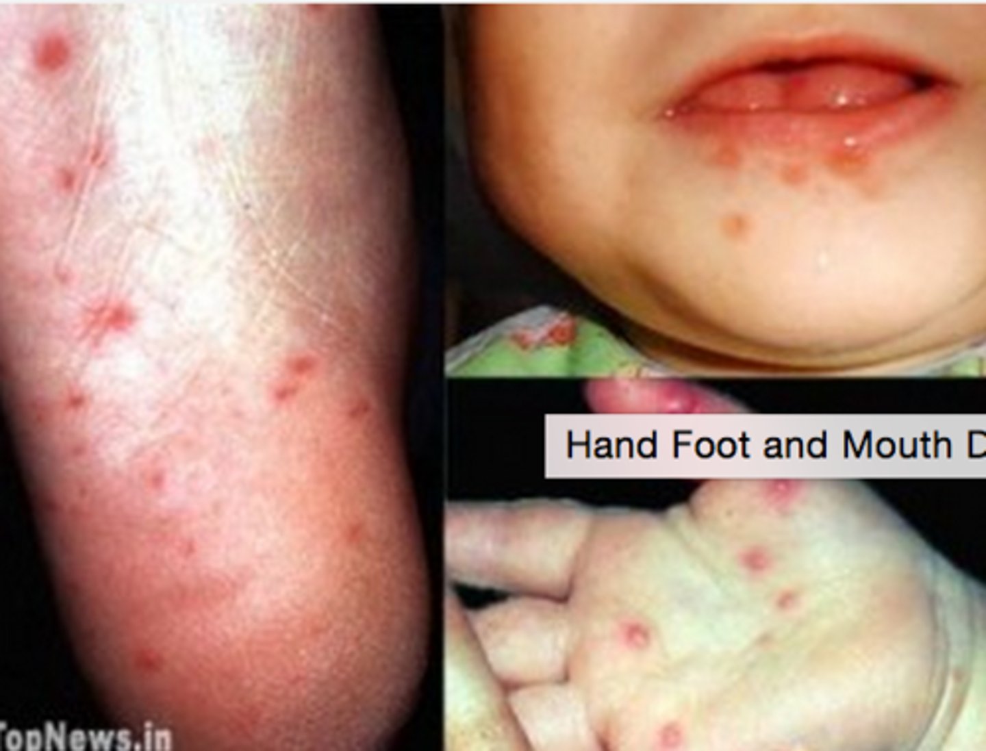 <p>coxsackievirus</p><p>- fever irritability, loss of appetite, blistering</p><p>- peeling of palm and soles, nails fall off</p>