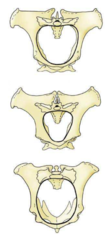 <p>a circular line the passes along the promontory of the sacrum dorsally, the wings of the ilia laterally and ends in the pecten of the pubis ventrally</p>