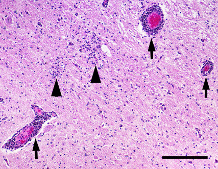 <p>Perivascular infiltration</p>