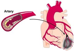 <p>Insufficient blood flow in one or more coronary arteries.</p>