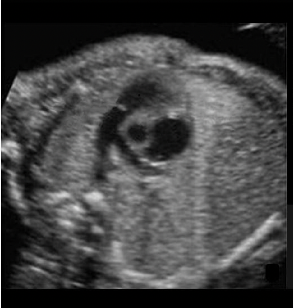 <p>Locate the right pulmonary artery</p>