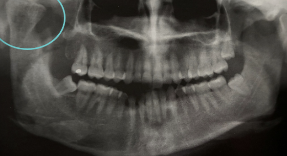 <p>excessive growth of condyle; due to neoplasms and endocrine disturbances </p>