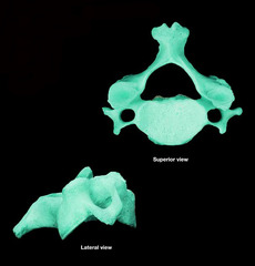 <p>disarticulated</p>