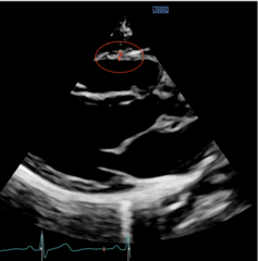 <p>Right Ventricular Free Wall (RVFW)</p>