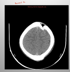 <p>CT scanning</p>