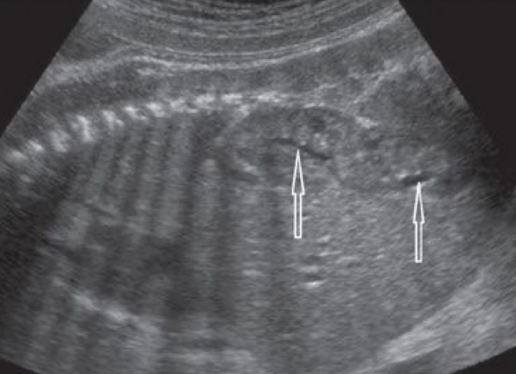 <ul><li><p>absence of kidney in its normal position</p></li><li><p>ipsilateral adrenal gland flattening</p></li><li><p>ectopic kidney is usually in pelvis and may be malrotated</p><ul><li><p>crossed ectopia and cross-fused ectopia is possible</p></li></ul></li></ul><p></p>