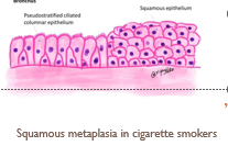 <p>change of epithelium at a site, or location, from one type to another <span style="color: red;">(change in cell type)</span></p><ul><li><p>epithelium normally present at a site cannot handle the new environment so it converts to a type of epithelium that can adapt.</p></li></ul><p></p>