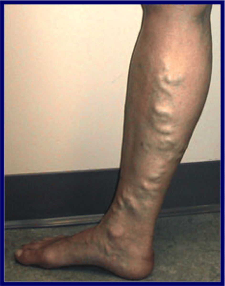 <p>abnormally swollen, twisted veins with defective valves; most often seen in the legs</p>