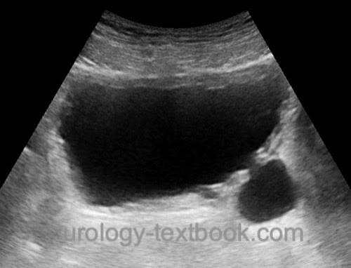 <p>bladder diverticulum</p>