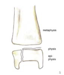 <p>A fracture through the Physis & Epiphysis (spares Metaphysis):</p><p>- Fracture line passes through the hypertrophic layer of the Physis & extends to split the Epiphysis → damages the Physis' reproductive layer</p><p>- More common in older children</p><p>- Chronic disability is common b/c the physis is damaged</p>