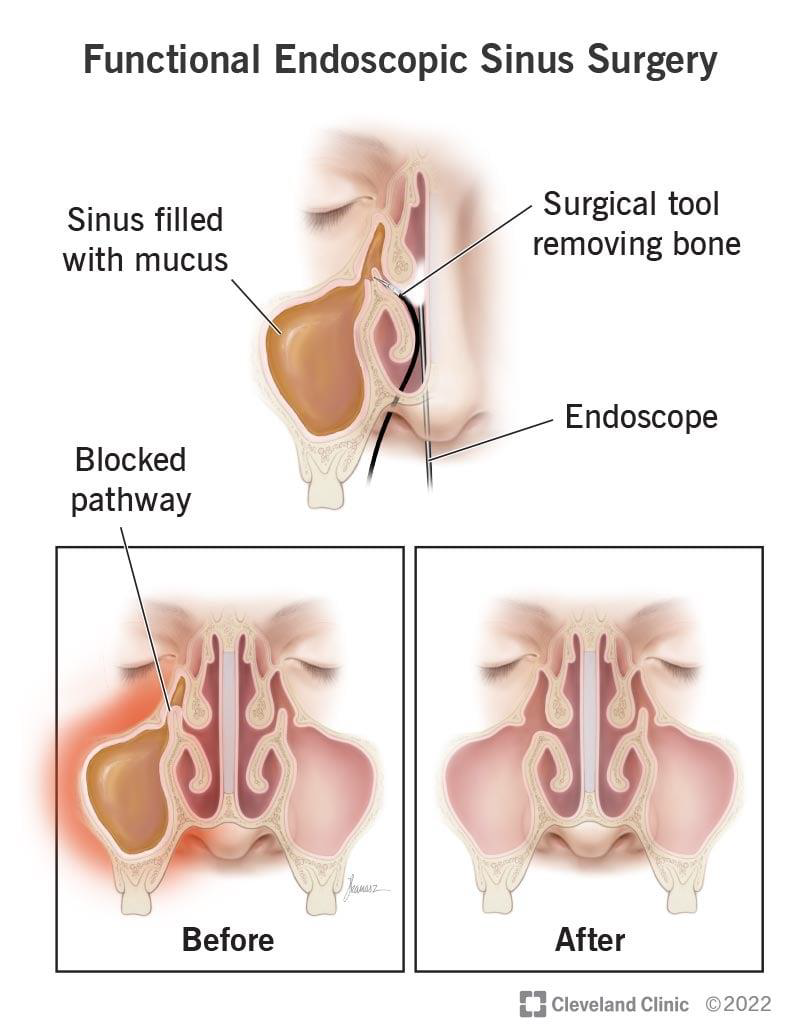 <ul><li><p>procedure to remove blockages and treat other problems in the sinuses using an endoscope</p></li><li><p>thin, rigid tube with a camera and a light</p></li><li><p><strong>FESS- functional endoscopic sinus surgery</strong></p><ul><li><p>aim to restore ventilation of the paranasal sinuses with widening the ostia and preserve the function</p></li></ul></li></ul><p></p>