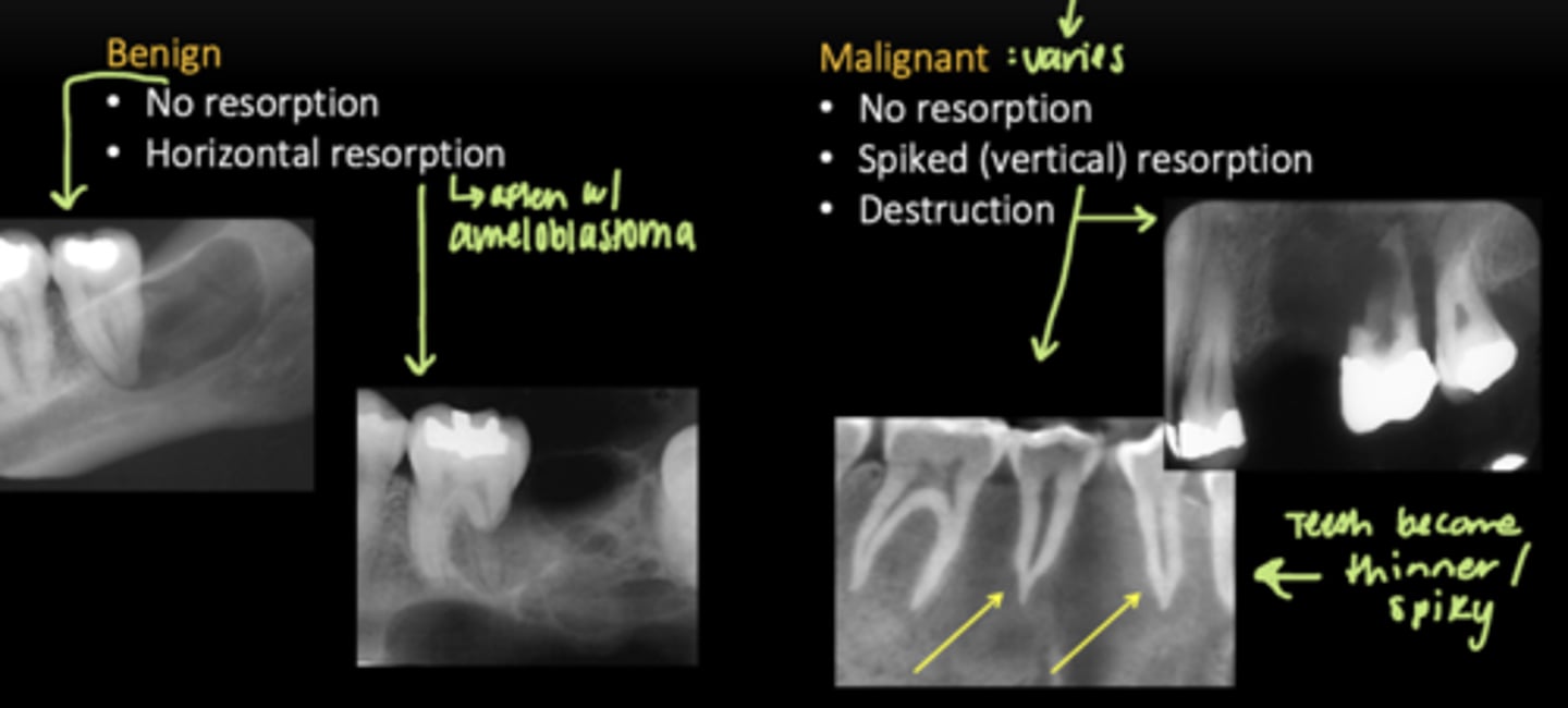 <p>Benign: </p><p>- No resorption </p><p>- Horizontal resorption </p><p>Malignant:</p><p>- No resorption </p><p>- Spiked (vertical) resorption </p><p>- Destruction </p>