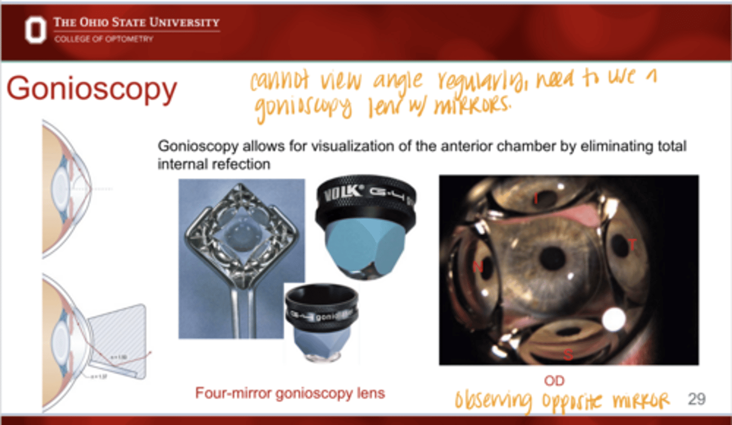 <p>Four Mirror Gonioscopy View (Pic)</p>