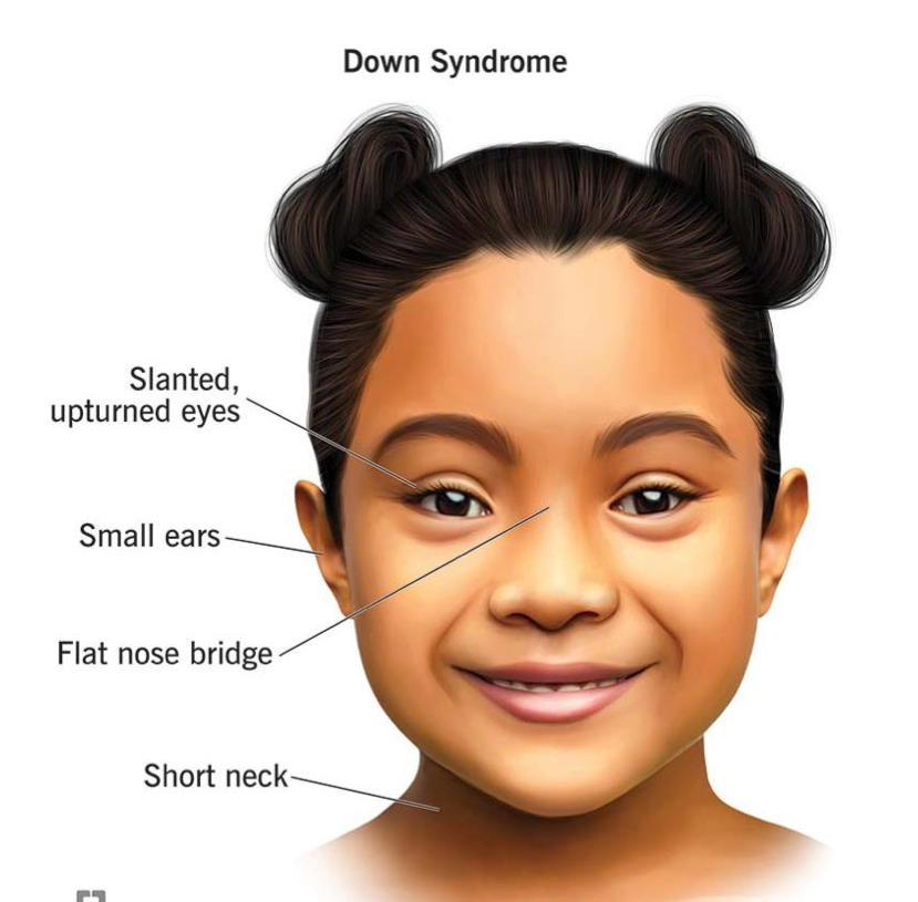 <p>+cardiac anomaly, recurrent otitis media, URI</p>
