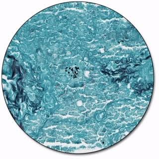 <p>Grocott’s Methenamine Silver (GMS)</p>