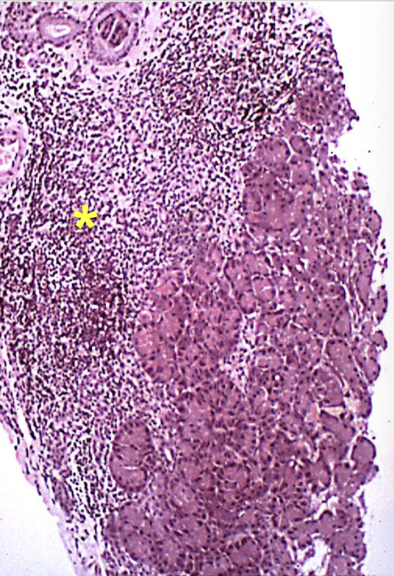 <p>intense T cell infiltration (preceding acinar atrophy) → <strong>CD4</strong>+<strong> </strong>and <strong>CD8+</strong> lymphocytes infiltrate bt &amp; w/in acini → lymphoid follicles, plasma cells, &amp; marcrophages present during subclinical stage</p>