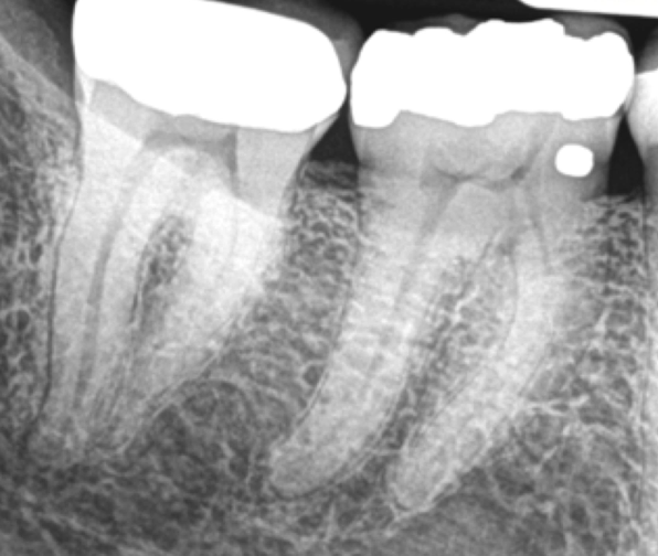 <p>What are the steps in instrumentation of mandibular molars?</p>