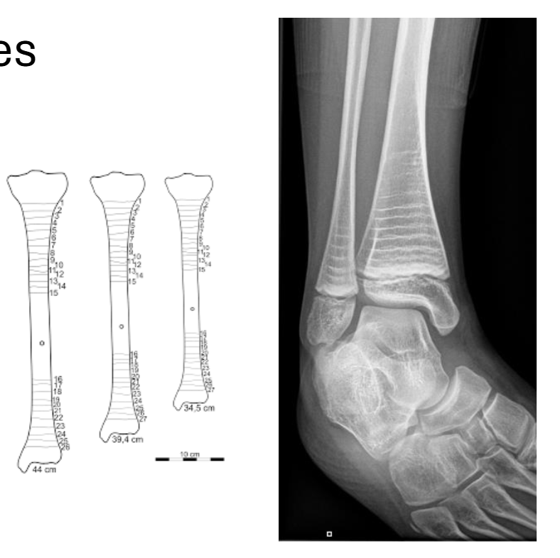 <p>Pathology: Metabolic Diseases Example: Harris Lines</p>