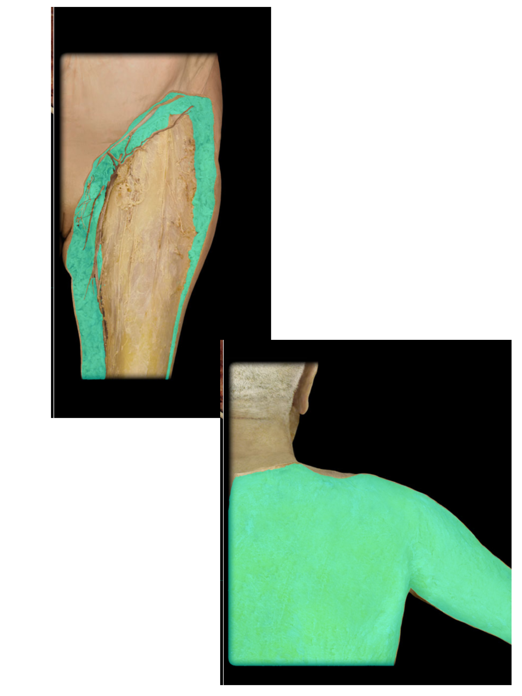 <p>Subcutaneous tissue</p>