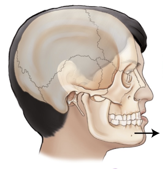<p>what is the name of the movement where the jaw is moved forward from its normal position?</p>