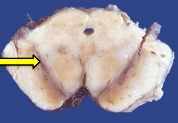 <p>Which of the following is the most complete and accurate answer concerning the structure indicated by X?</p><p>It is the substantia nigra</p><p>It is the substantia nigra and it is located in the tectum of the midbrain</p><p>It is the substantia nigra and is considered to be part of the basal ganglia</p><p>It is the substantia nigra and is considered to be part of the subthalamus</p><p>It is the substantia nigra and contains mostly serotonergic neurons</p>