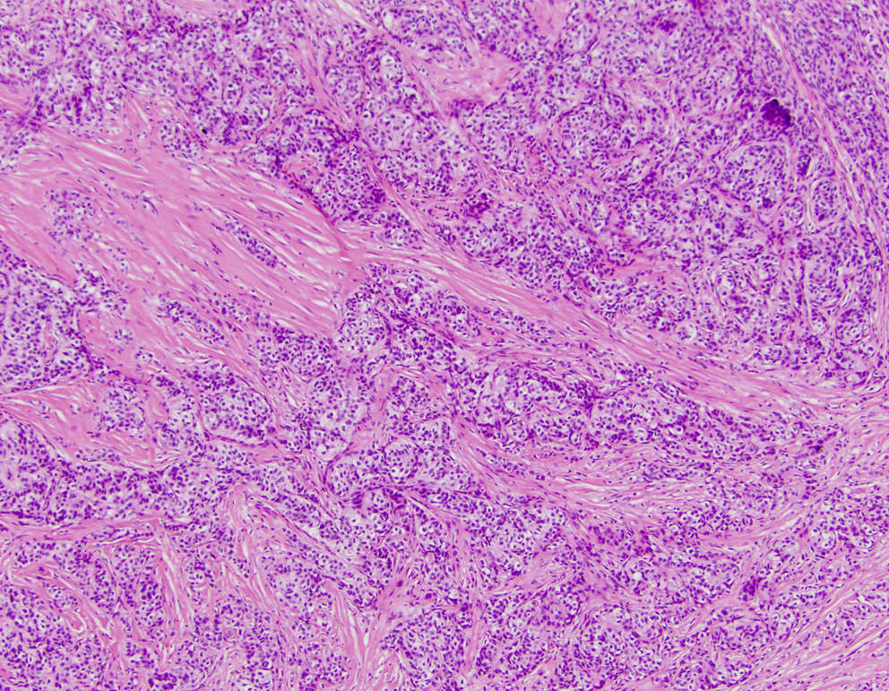 <p>tumeur de l’estomac chez jeune patient </p><p>1) Diagnostic </p><p>2) Histologie</p><p>3) IHC</p><p>4) moléculaire</p>