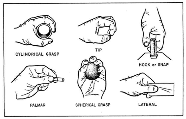 <p>Opposition involves rotation of the carpometacarpal joint of the thumb in order to align the thumb pad with one or all of the digit pads.&nbsp; Opposition of the thumb is found in most grasp patterns and allows for execution of a variety of activities such as turning a door knob.</p><p><br></p><p><strong>1. </strong>Cylindrical grasp is used when holding a cylindrically shaped object such as a can of soda or soup.&nbsp; This grasp involves thumb opposition, finger adduction and flexion.</p><p><strong>2. </strong>Pad-to-pad prehension is used when holding onto a coin.&nbsp; This grasp involves thumb opposition and slight flexion of the thumb joints.&nbsp; It also involves finger flexion at the metacarpophalangeal and proximal interphalangeal joints and either flexion or extension of the distal interphalangeal joints of the fingers.</p><p><strong>3. Hook grasp is used when holding onto a briefcase handle or purse.&nbsp; This grasp involves the metacarpophalangeal joints in neutral, with finger flexion at both the proximal and distal interphalangeal joints.&nbsp; The thumb is positioned in extension with this grasp and would not be affected by the inability to perform opposition.</strong></p><p><strong>4. </strong>Spherical grasp is used when holding onto a round object such as a softball or an apple. This grasp involves thumb opposition and finger flexion and abduction.</p><p></p><p></p>
