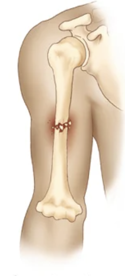 <p>bone shattered</p>