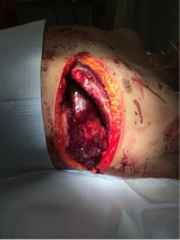 <p>- Absence of qualified surgeon</p><p>- Blunt chest trauma with pulseless electrical activity (low chance of survival)</p><p>- Penetrating wounds with no electrical activity on EKG</p><p>- No signs of life (reactive pupils, spontaneous movement, organized EKG)</p>